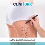 شد ترهلات الفخدين بالليزر